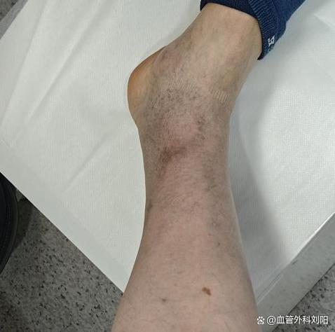 沈阳下肢血管外科最好的医院排名