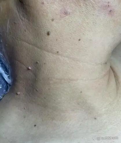 手臂里面摸到个圆球硬疙瘩