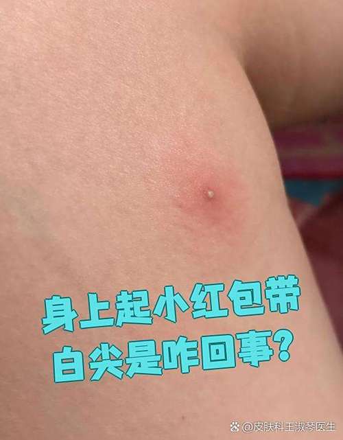 红疙瘩中间有小白点凸起