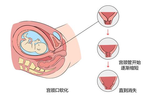 宫口软化是什么意思缩略图