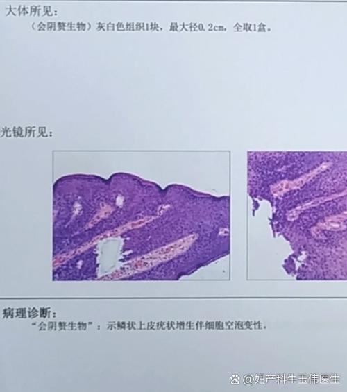 阴口边上长了个肉疙瘩什么原因