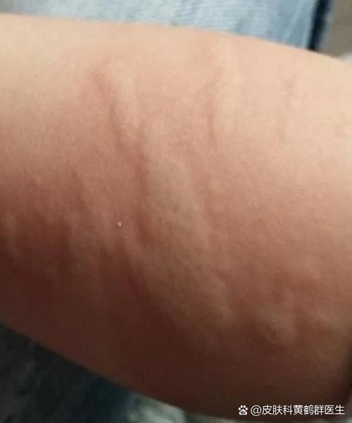 身上一挠痒痒就起疙瘩