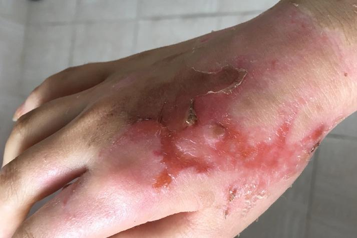 烫伤结痂很厚很硬开裂