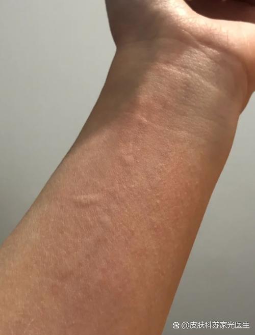 一抓皮肤就起疙瘩奇痒
