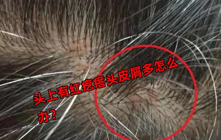 头皮上红色的小疙瘩