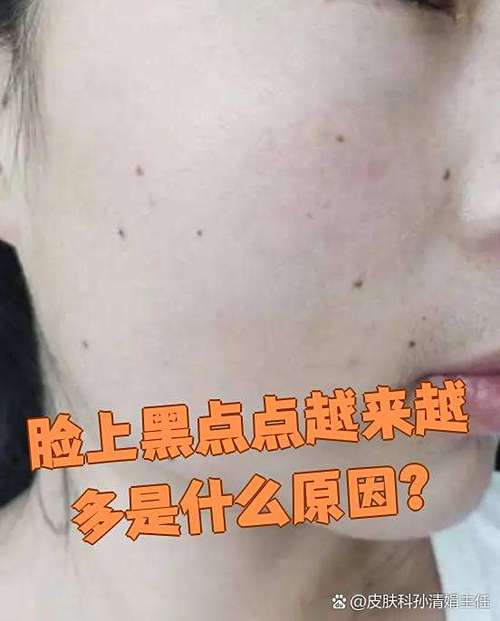 脸上突然有黑点要警惕缩略图