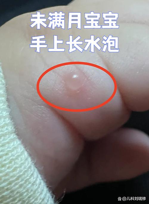 大拇指长了透明硬水泡缩略图