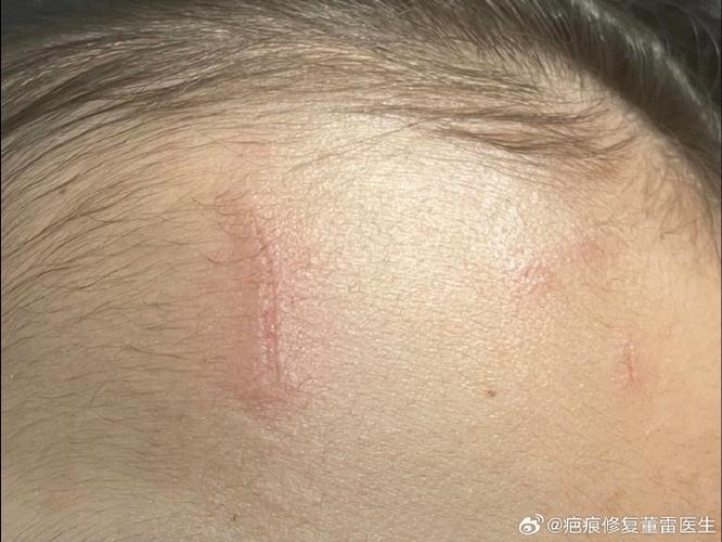 身上莫名有刮痕结痂