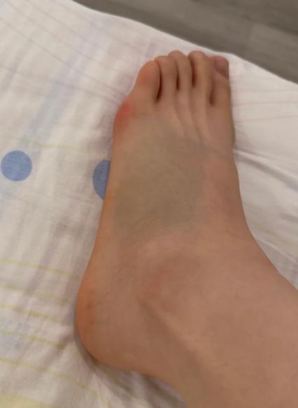 脚崴后脚踝外侧凸起一个鼓包