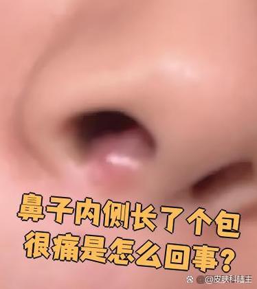 鼻子里有个疙瘩一摸就疼