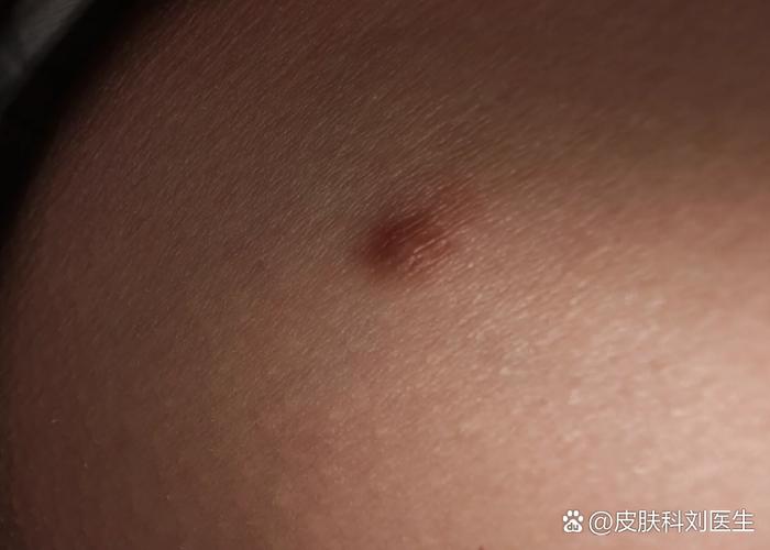 灰白色疙瘩图片