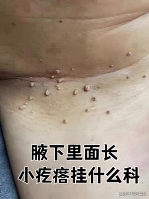 腋窝下有疙瘩怎么回事