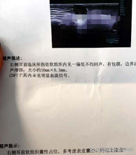 手机听筒清理灰尘超声波