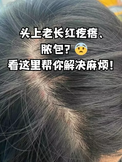 头皮红疙瘩