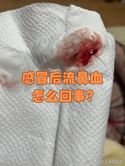 什么病毒感染会引起流鼻血图标