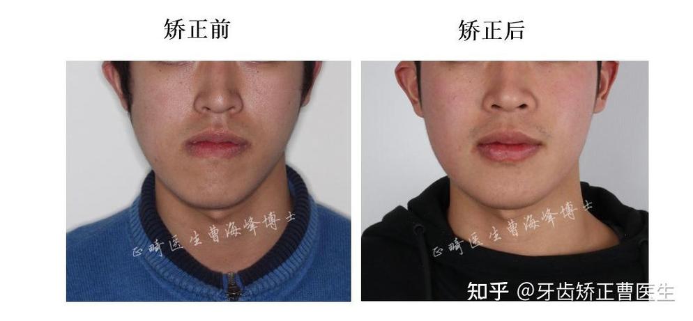 拍照脸歪嘴歪怎么矫正缩略图