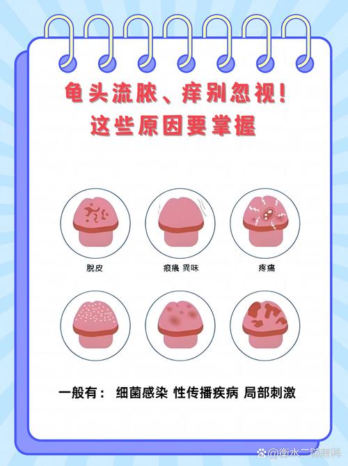 男性真菌感染是怎么引起的图标