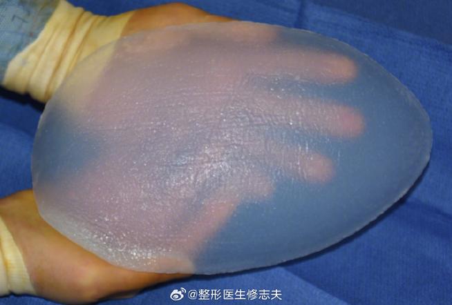 硅胶假体