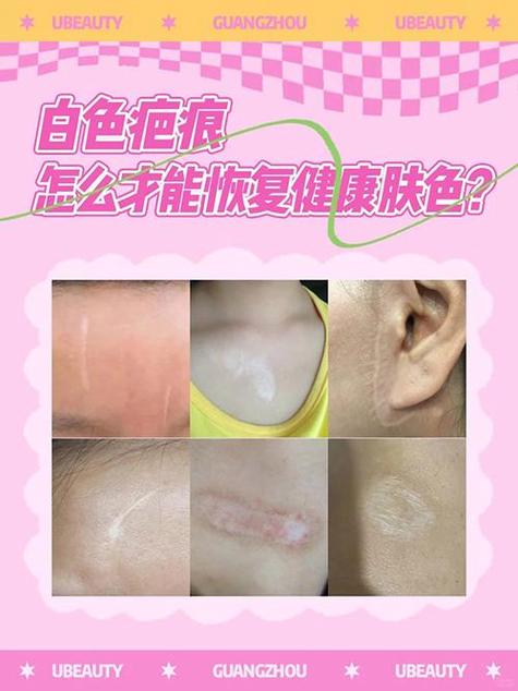 疤痕恢复正常肤色还会变淡化吗图标