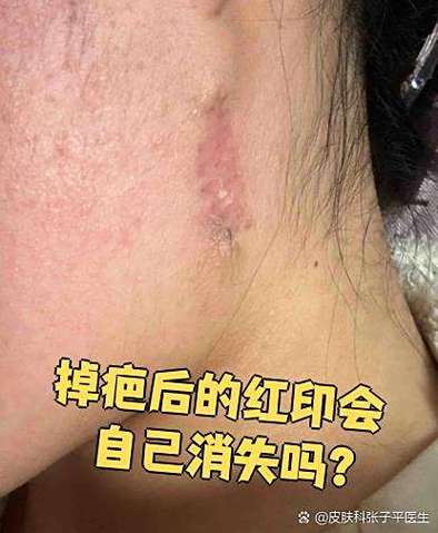 疤痕发红多久会淡化
