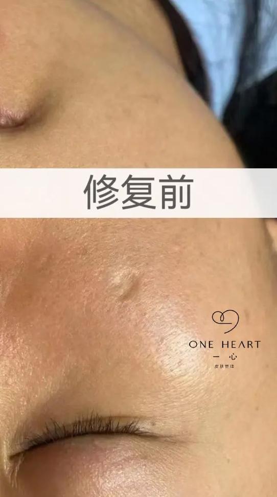痘坑修复排行榜第一名截图