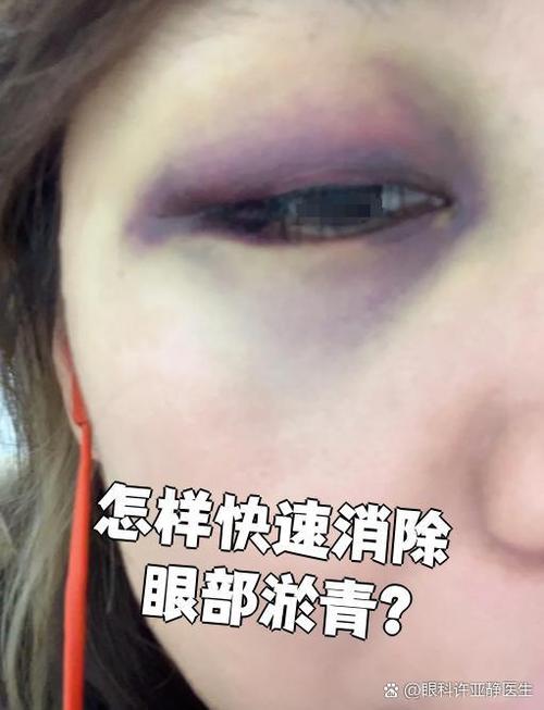 眼睛撞肿了怎么快速消肿淤青截图