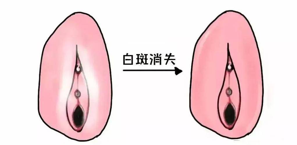 什么是外阴白斑图片截图