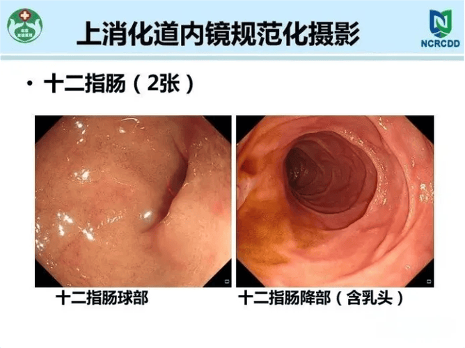 12指肠球部是指哪个部位