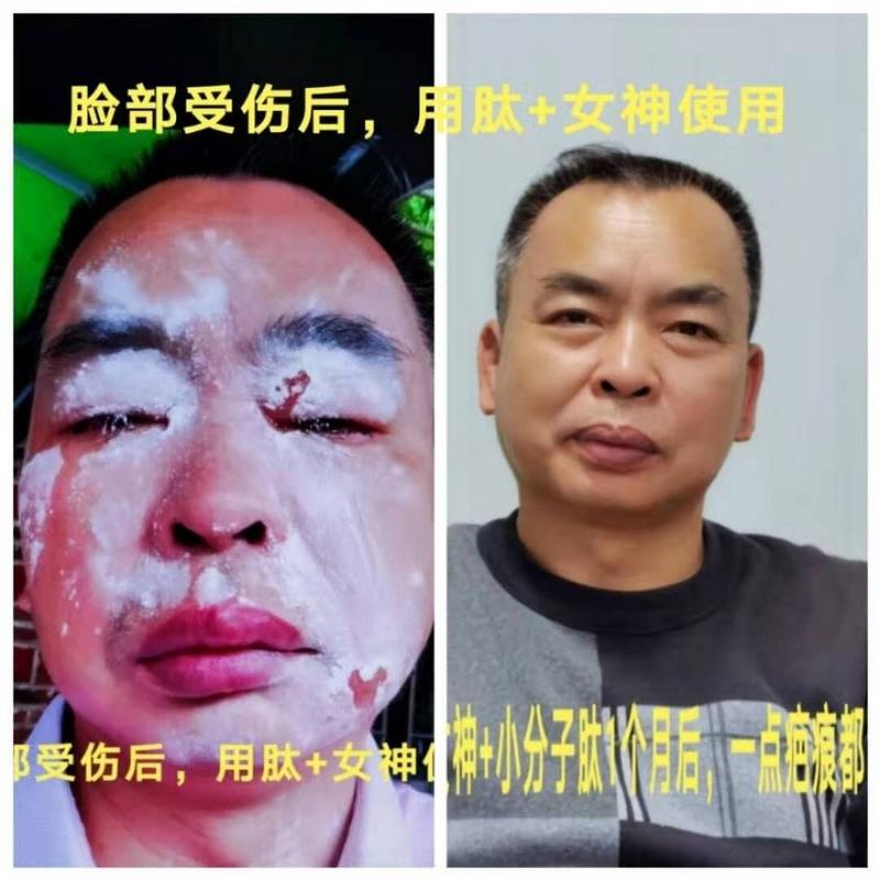 肽能修复疤痕吗缩略图