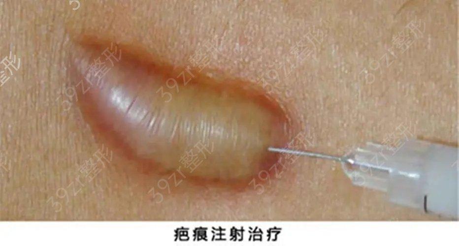 打了4次针疙瘩疤痕又长了截图