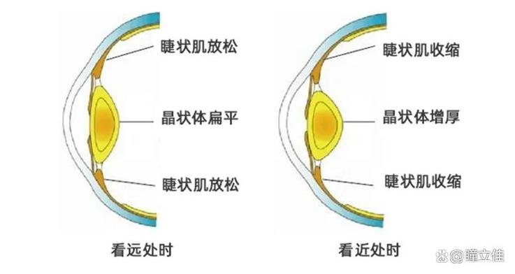 近视眼用凸透镜还是凹透镜截图