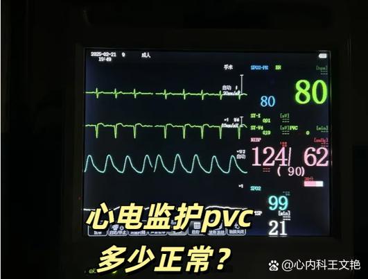 PVC心电监护缩略图