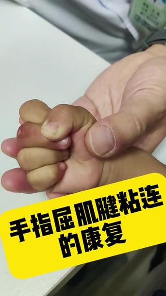 治疗甲沟炎需要多少钱截图