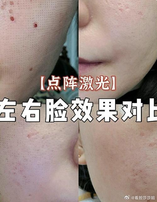 痘印有必要做激光吗截图