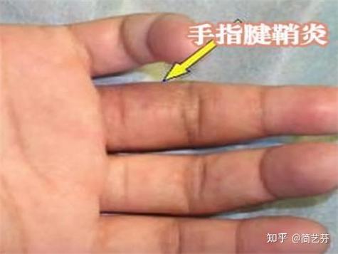 手指一碰手机屏幕就疼