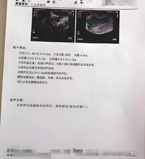 宫外孕打了甲氨蝶呤5天后hcg反升截图