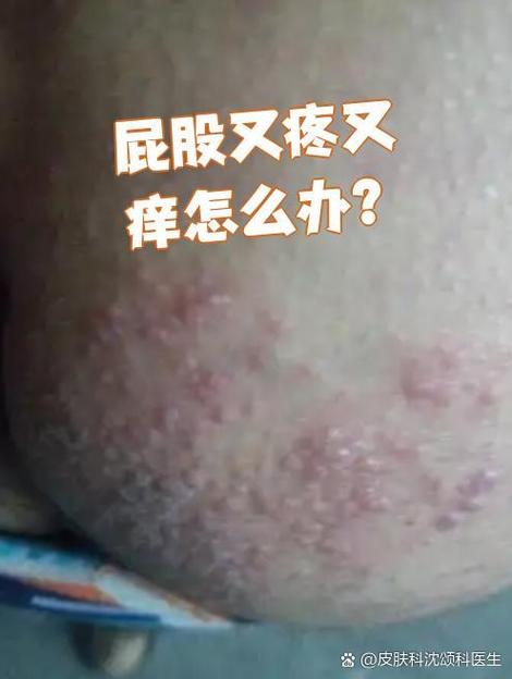 屁股疼痒截图