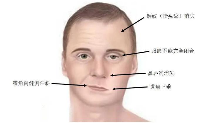 牙疼嘴巴歪了是什么原因造成的