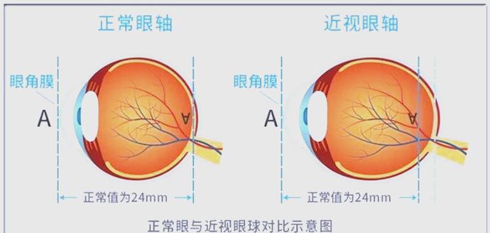 防控镜片有必要吗图标