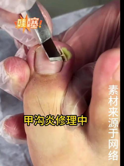 甲沟炎模拟器游戏解压最新版缩略图