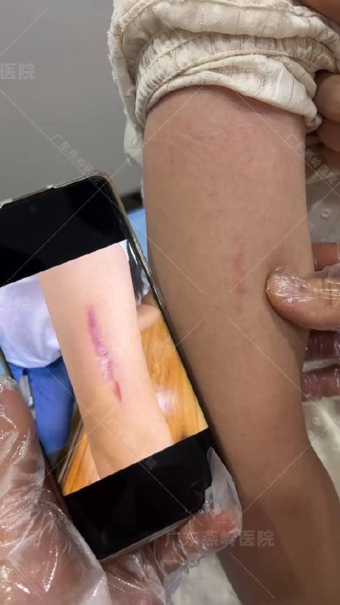 疤痕能恢复到正常皮肤吗图标