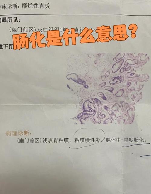 肠化是什么意思