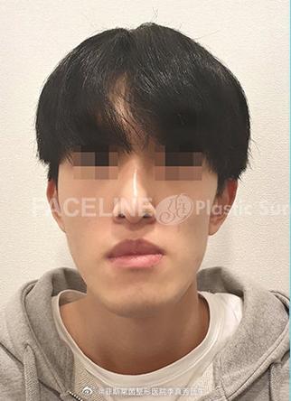 自拍的时候嘴巴歪了怎么办缩略图