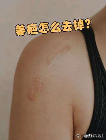 疤痕皮肤