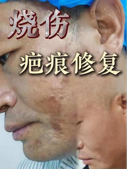 修复烫伤疤痕最好的方法图标