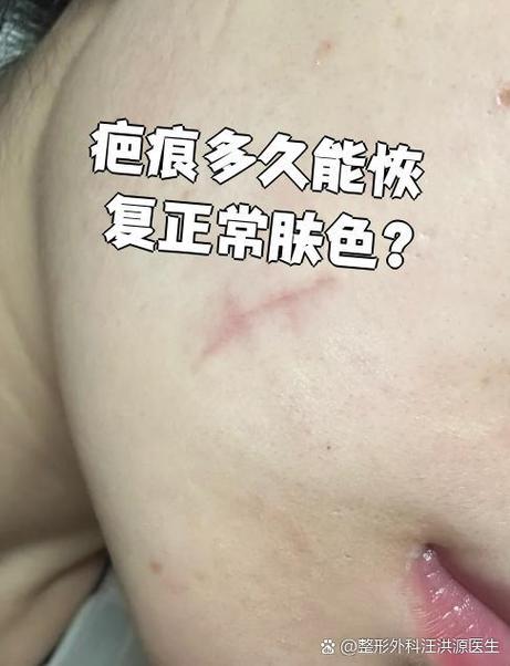 色素疤痕能恢复到正常肤色吗?图标
