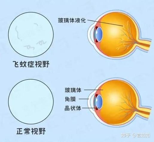 眼睛有白影飘动怎么治图标