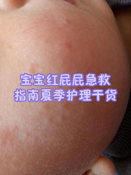鼻尖很红但是不疼