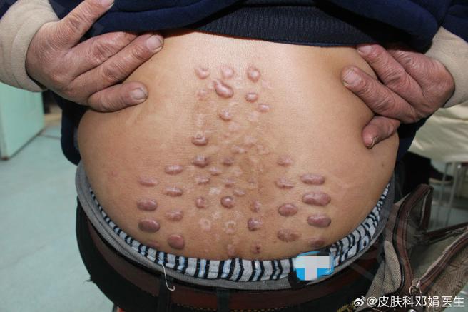 疤痕增生图片真实照片游戏截图