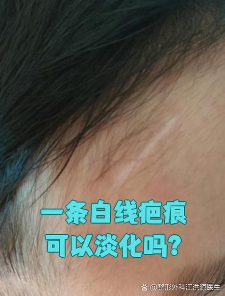 手上有白色线状像疤痕